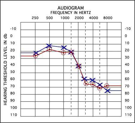 Audiogram chart with example points and lines